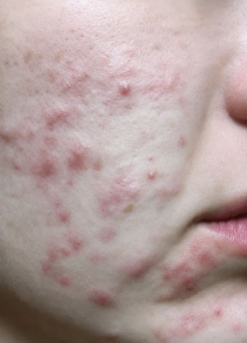 Acne before treatment