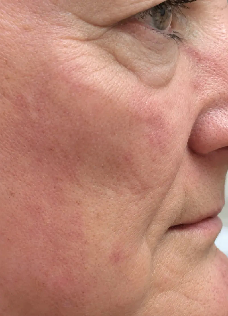 Fine Lines & Wrinkles after treatment