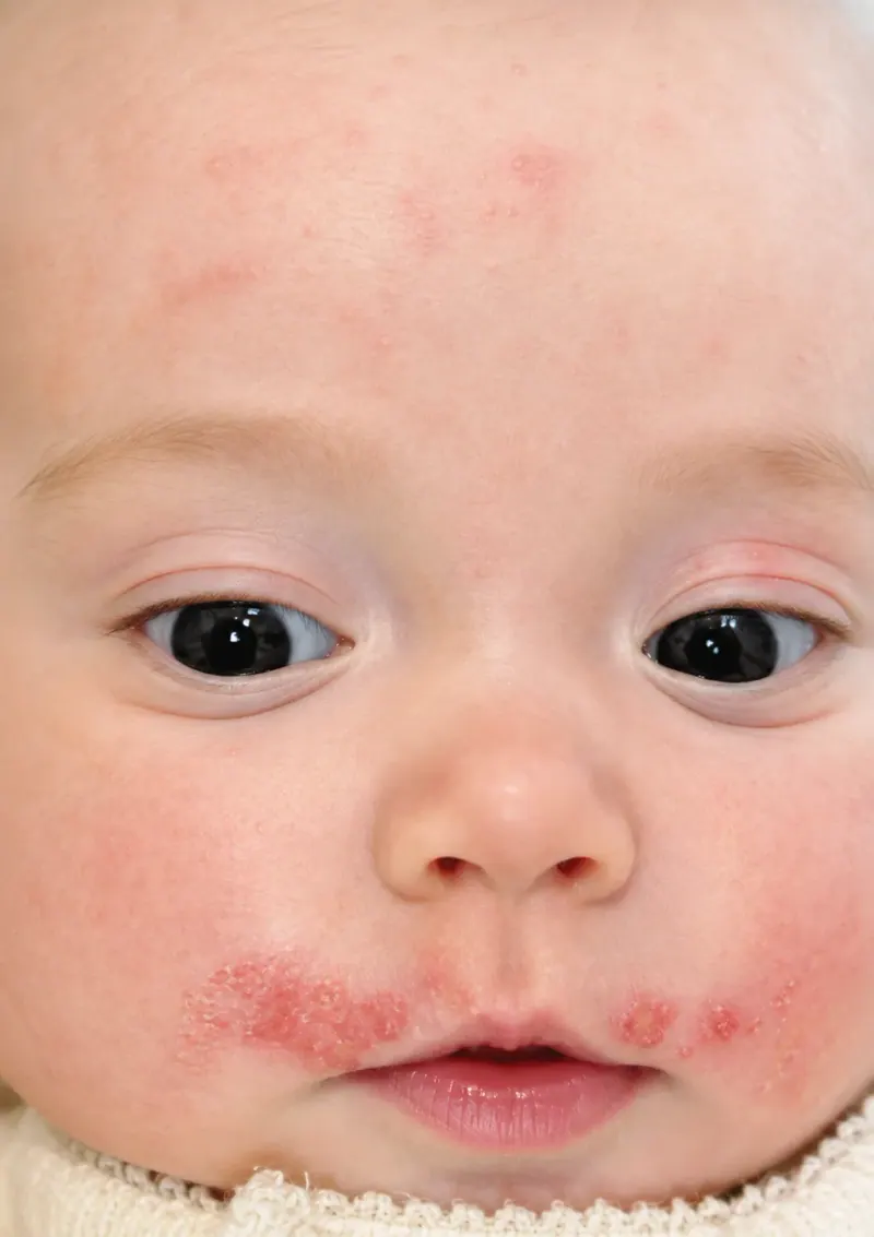 Eczema before treatment