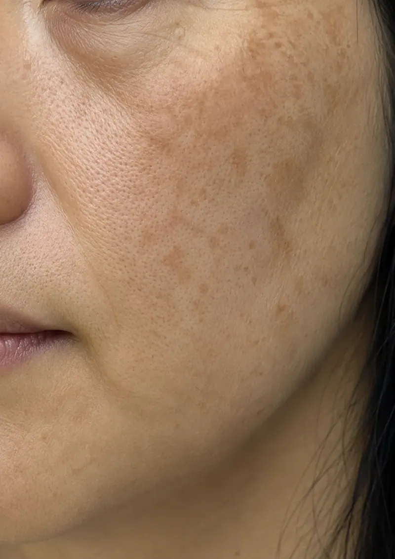 Melasma & Hyperpigmentation before treatment