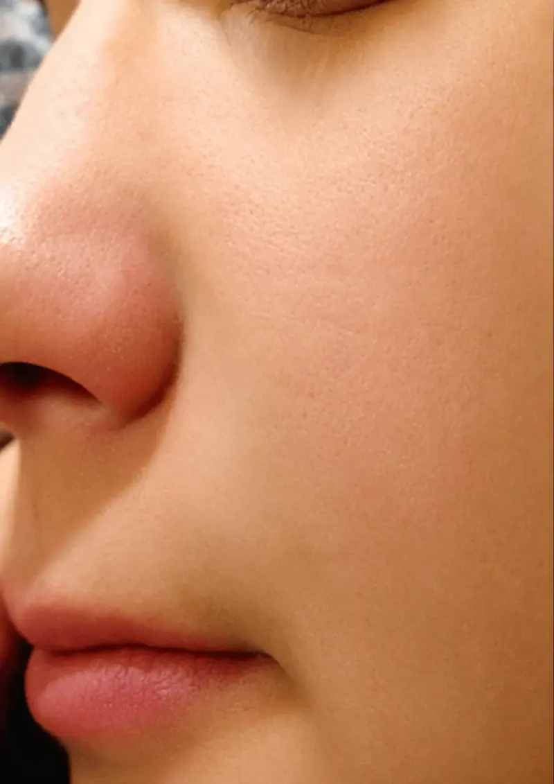 Perioral Dermatitis after treatment