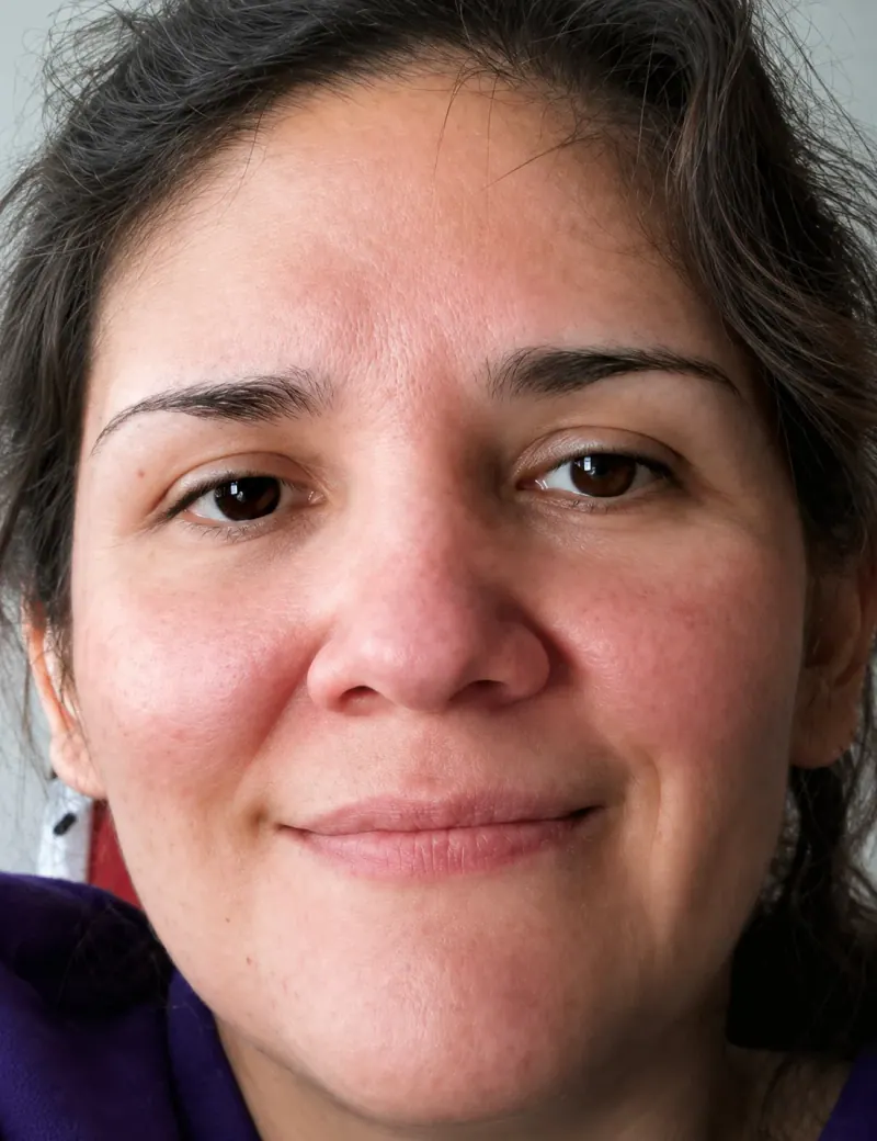 Rosacea after treatment