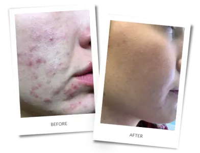 Before and after photographs of a patient treated for acne