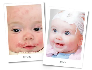 Before and after photographs of a patient treated for eczema