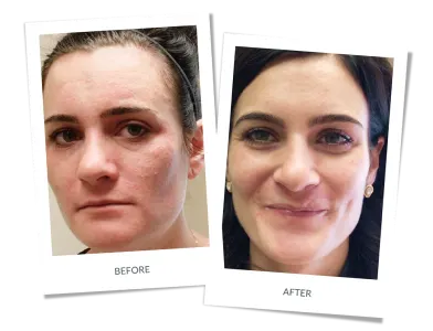 Before and after photographs of a patient treated for perioral dermatitis