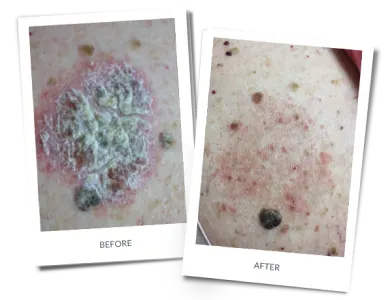 Before and after photographs of a patient treated for psoriasis