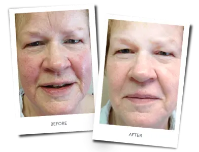 Before and after photographs of a patient treated for rosacea