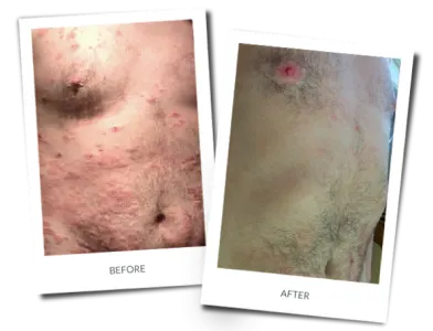 Before and after photographs of a patient treated for severe atopic dermatitis